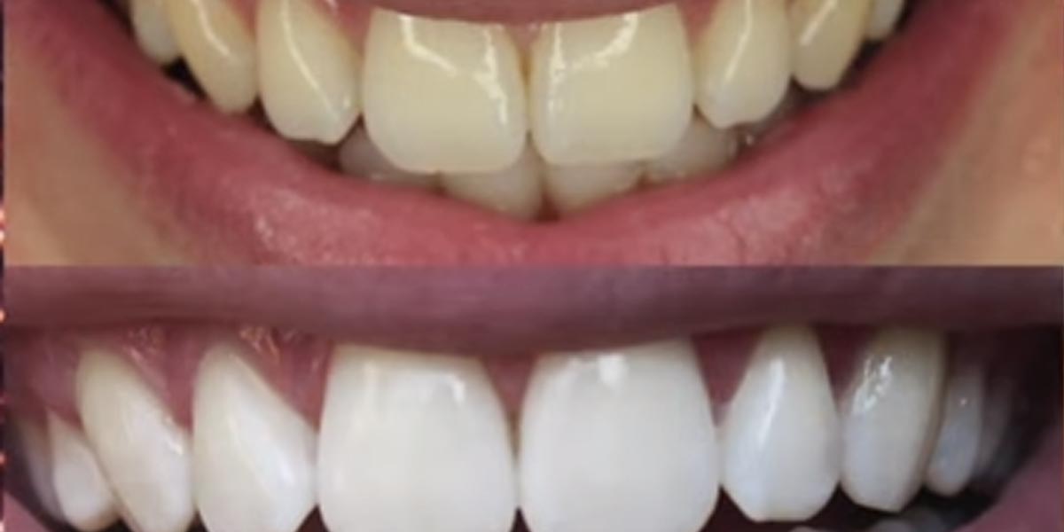 She Finds This Amazing And Cheap Trick To Whiten Her Teeth in 2 Minutes! (Watch!) | DIY Joy Projects and Crafts Ideas