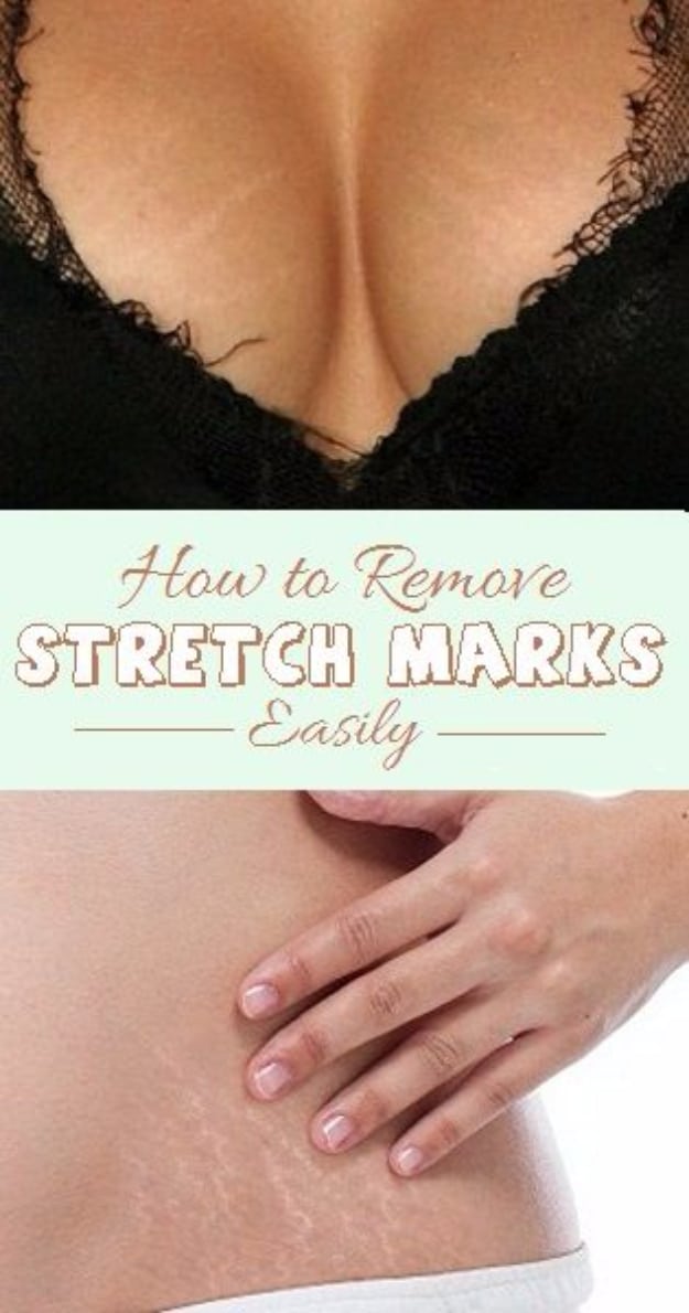 DIY Beauty Hacks - Remove Stretch Marks Easily - Cool Tips for Makeup, Hair and Nails - Step by Step Tutorials for Fixing Broken Makeup, Eye Shadow, Mascara, Foundation - Quick Beauty Ideas for Best Looks in A Hurry #beautyhacks #makeup