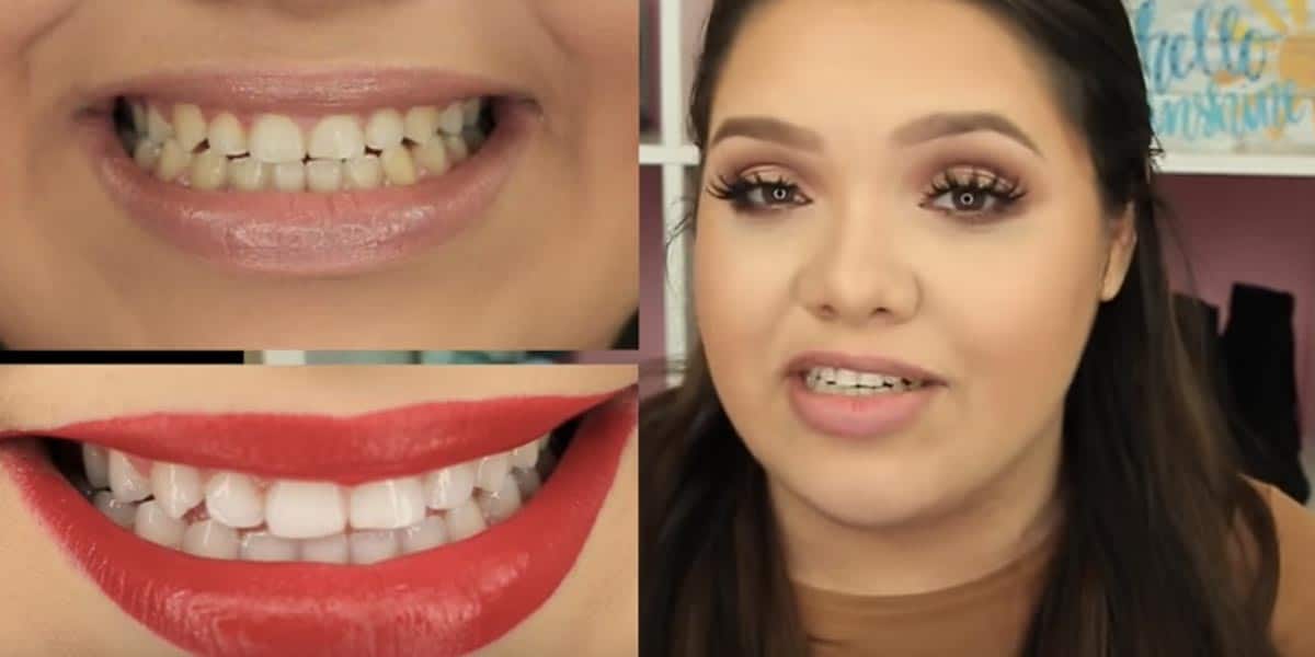 10 Simple Life Hacks For Teeth Whitening That Everyone Should Know...