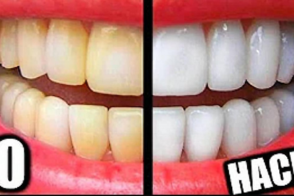 How to Whiten Teeth At Home - DIY Hacks for White Teeth