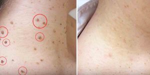 Many Of Us Struggle With Dreadful Skin Tags And These 5 Home Remedies Can Help!