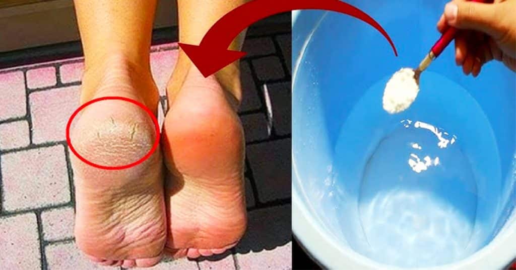 How To Get Rid Of Cracked Heels - DIY Cracked Heels - Home Remedy Hacks