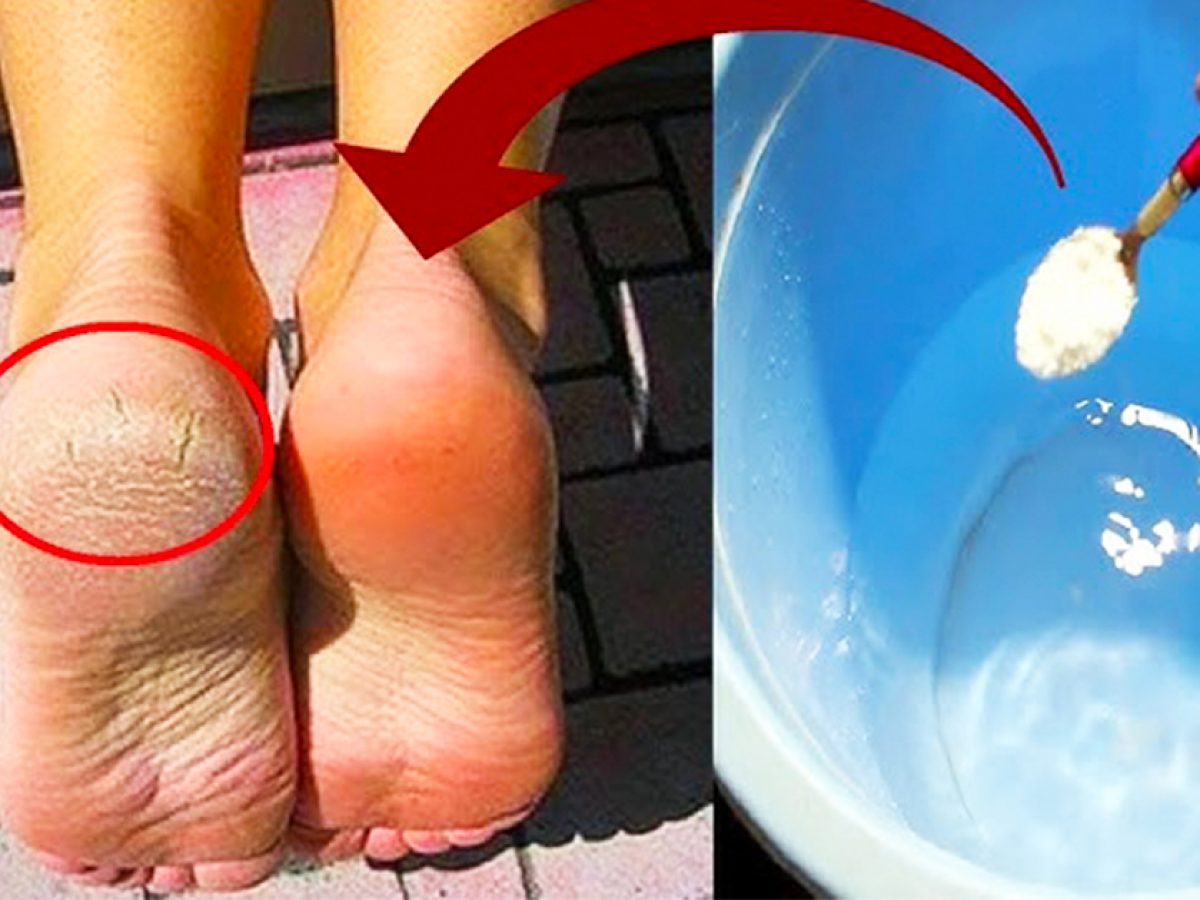 What Really Causes Cracked Heels—and How to Get Rid of Them