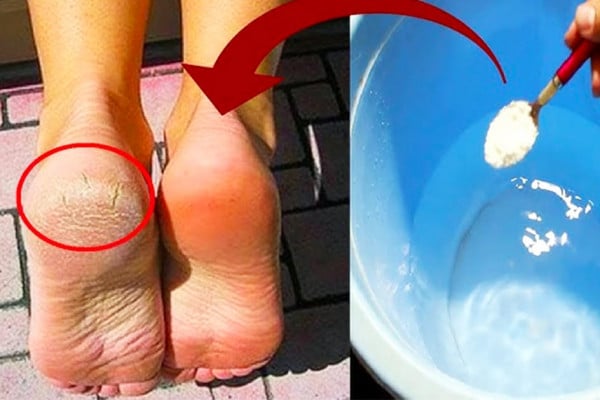 How To Get Rid Of Cracked Heels - DIY Cracked Heels - Home Remedy Hacks