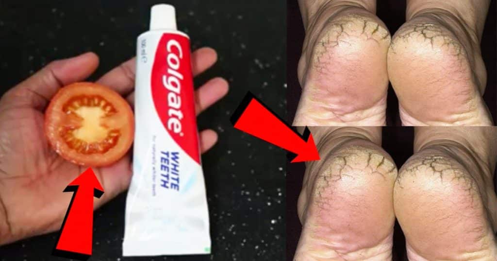 DIY Cracked Heels Remedy Using Toothpaste And Tomatoes - DIY Cracked Heels - Cracked Heels Home Remedies