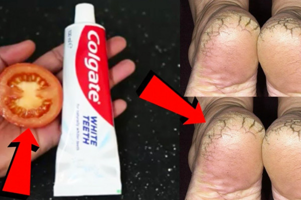 DIY Cracked Heels Remedy Using Toothpaste And Tomatoes - DIY Cracked Heels - Cracked Heels Home Remedies