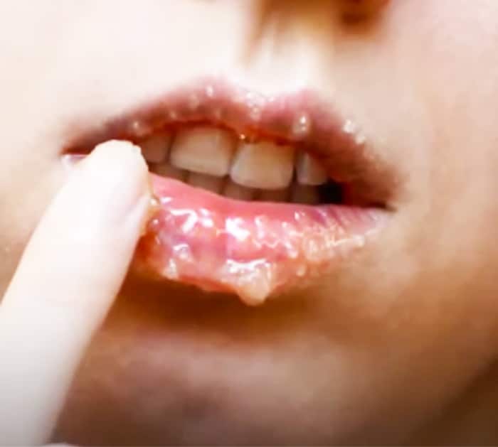 Best At Home Remedies To Get Rid Of Chapped Lips - How To Avoid Dry Lips - How To Keep Your Lips Moist In The Winter