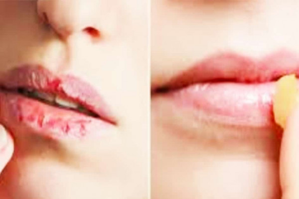Home Remedies To Get Rid Of Chapped Lips - DIY Chapped Lips - Home Remedies For Chapped Lips