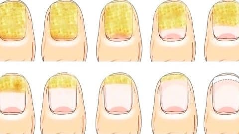How To Get Rid Of Toenail Fungus Naturally | DIY Joy Projects and Crafts Ideas