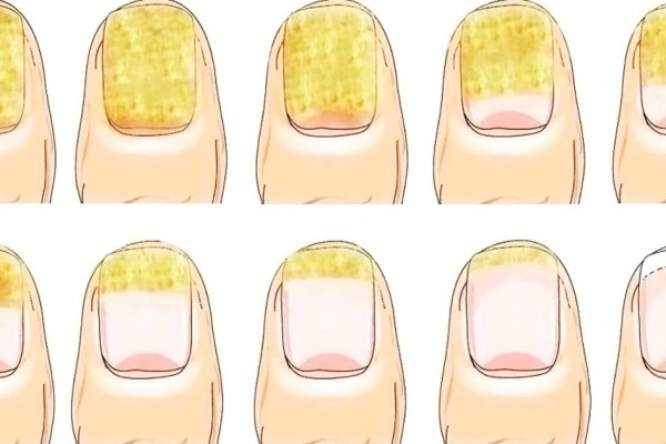 How to Get Rid of Toenail Fungus Fast and Naturally - DIY Natural Products for Toenail Fungus