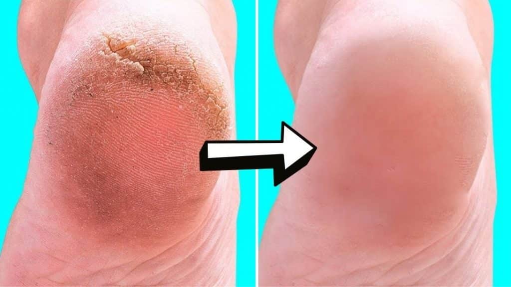 10 Natural Home Remedies For Silky Smooth Feet