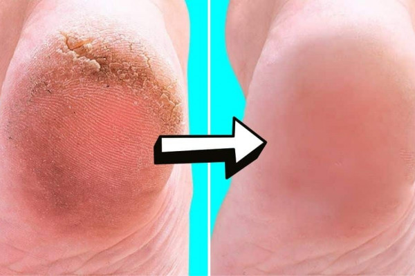 10 Natural Home Remedies For Silky Smooth Feet