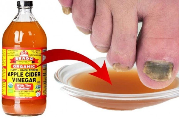 Easy And Cheap Toenail Fungus Treatment
