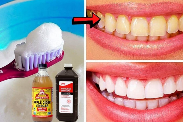 How To Whiten Your Teeth Naturally