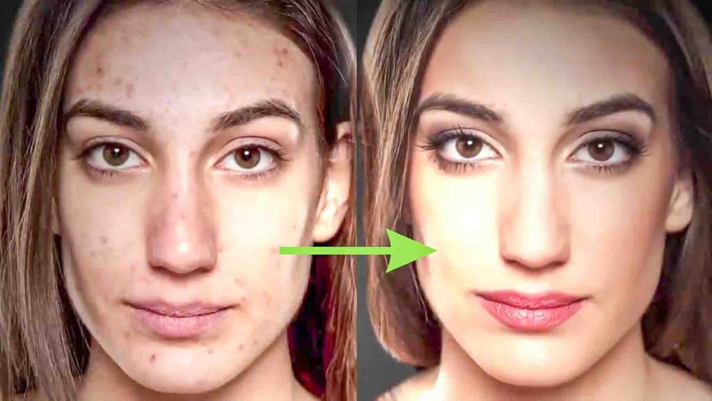 How to get rid of acne scars naturally