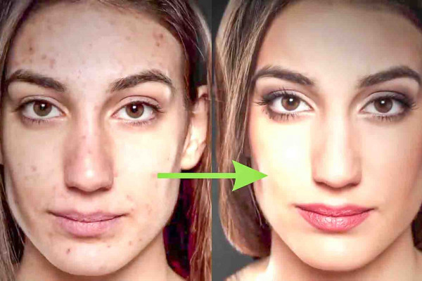 How to get rid of acne scars naturally