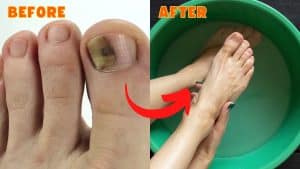 10 Effective & Natural Cure For Toenail Fungus