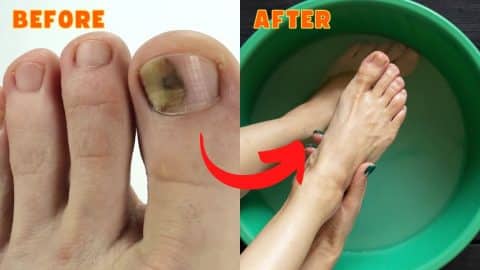 10 Effective & Natural Cure For Toenail Fungus | DIY Joy Projects and Crafts Ideas