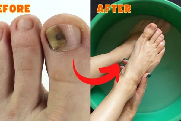 10 Effective & Natural Cure For Toenail Fungus