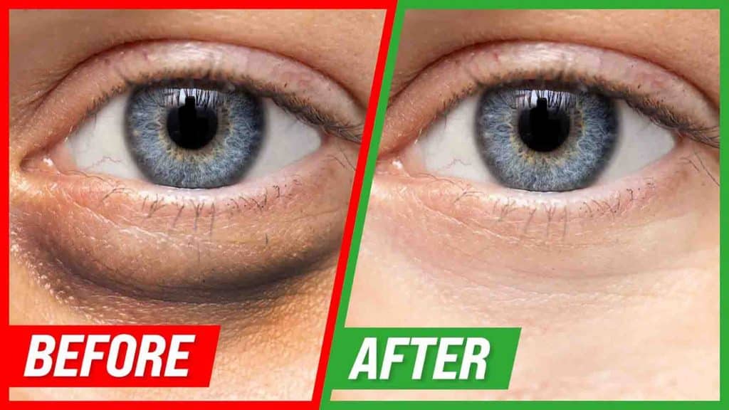 4 ways to get rid of puffy eyes and dark circles