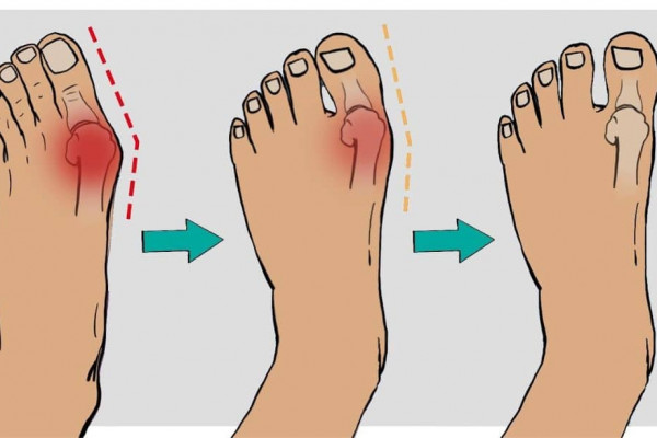 How to Fix Bunions in 5 Steps