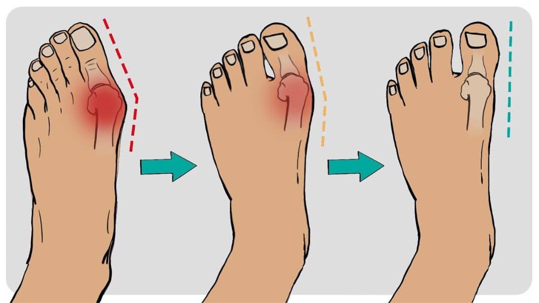 How to Fix Bunions in 5 Steps | DIY Joy Projects and Crafts Ideas