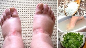 Home Remedies for Swollen Feet