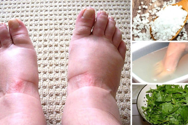 Home Remedies for Swollen Feet