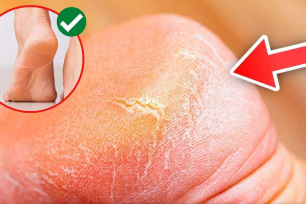 Homemade Remedy To Get Rid Of Calluses Fast