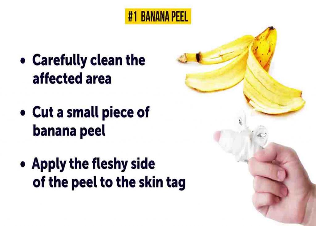 Applying a piece of banana peel to the skin tag to remove it