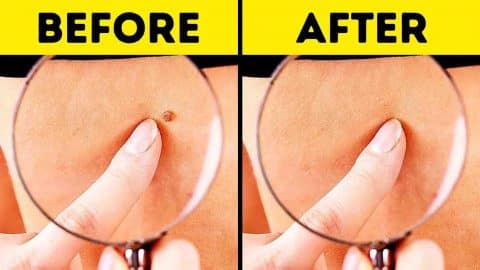 10 Effective Ways To Remove Skin Tags Naturally | DIY Joy Projects and Crafts Ideas