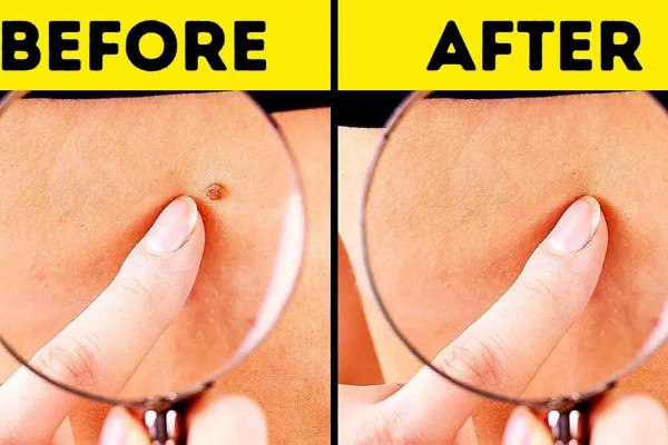 10 Effective Ways To Remove Skin Tags Naturally