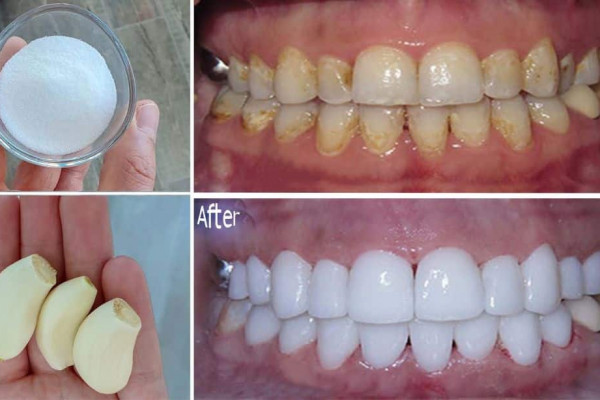 How to Whiten Dirty Yellow Teeth at Home
