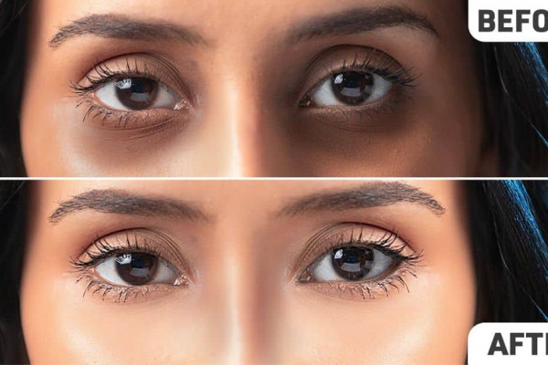 How to Remove Dark Circles Fast