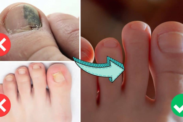 How to Treat Ingrown Toenails at Home