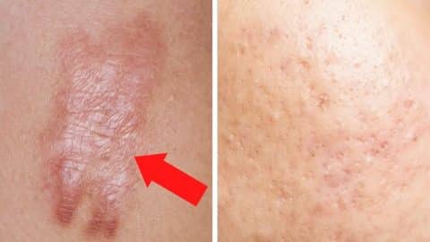 How to Get Rid of Scars Forever | DIY Joy Projects and Crafts Ideas