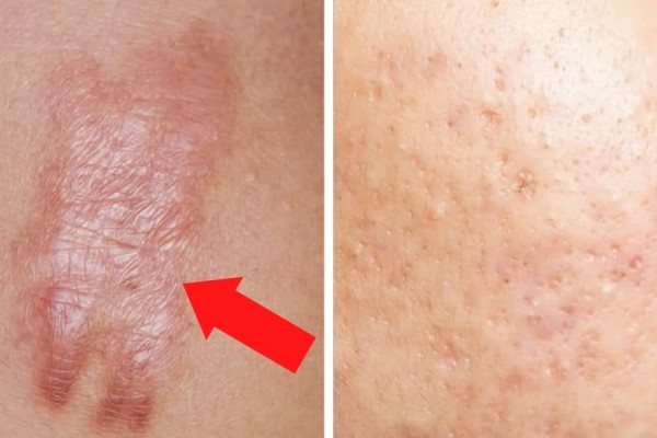 How to Get Rid of Scars Forever