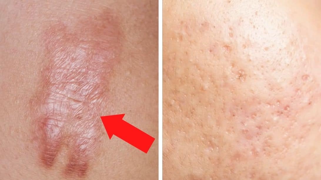 How to Get Rid of Scars Forever | DIY Joy Projects and Crafts Ideas