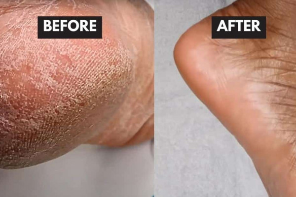 How to Remove Dead Skin Cells From Your Feet in Minutes