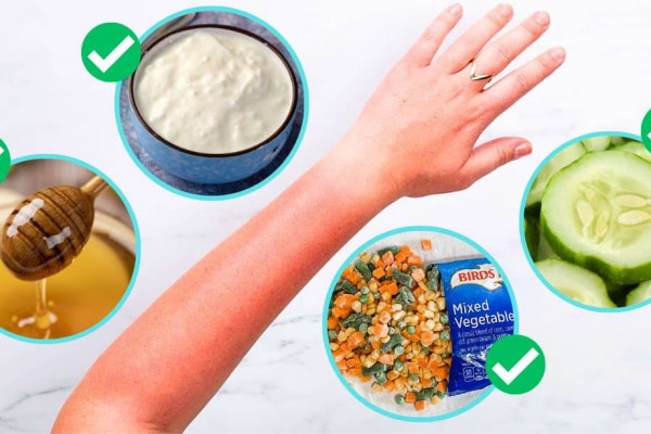 Instant Relief Remedies for Sunburn