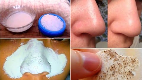 How to Remove Blackheads Naturally | DIY Joy Projects and Crafts Ideas