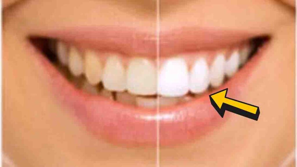 Finished DIY Teeth Whitening at Home in 2 Minutes, a completed DIY project