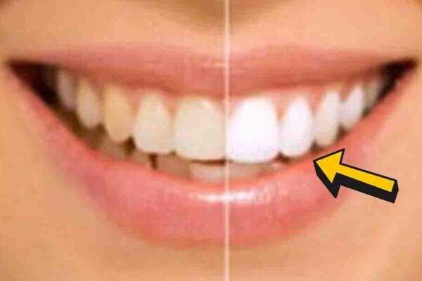 Finished DIY Teeth Whitening at Home in 2 Minutes, a completed DIY project