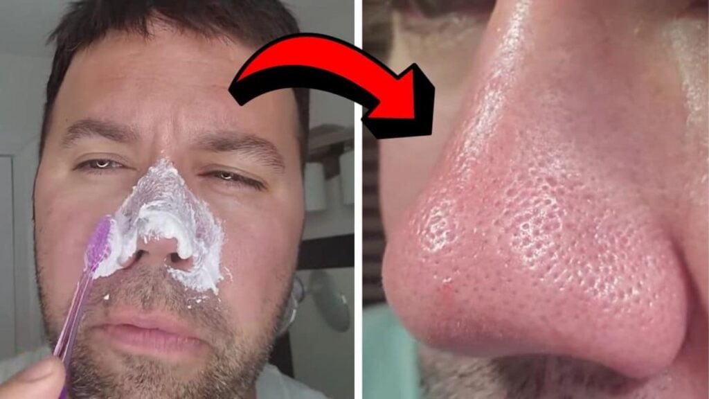 Finished Easy DIY Blackhead Removal Hack, a completed DIY project