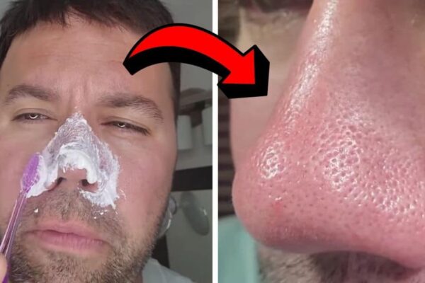 Finished Easy DIY Blackhead Removal Hack, a completed DIY project