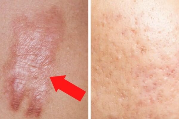 How to Get Rid of Scars Forever