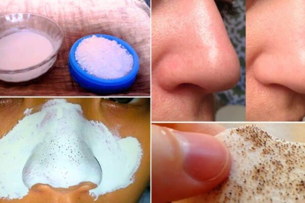How to Remove Blackheads Naturally