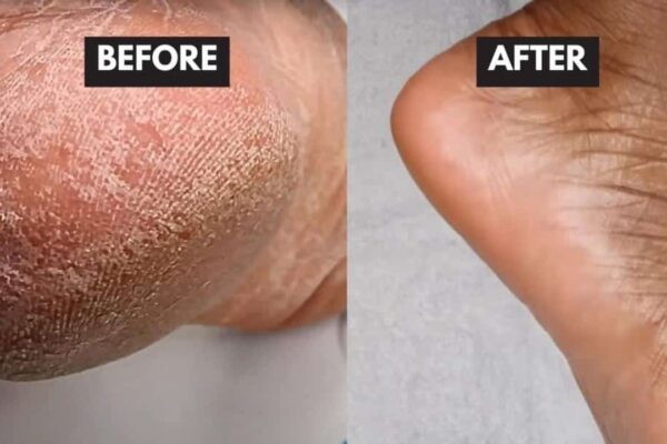 How to Remove Dead Skin Cells From Your Feet in Minutes