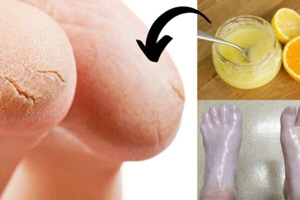 4 Effective & Simple Treatments for Cracked Heels, homemade and freshly served