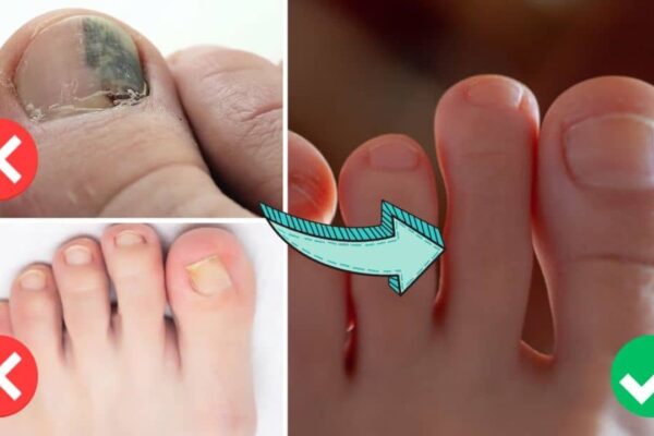 How to Treat Ingrown Toenails at Home